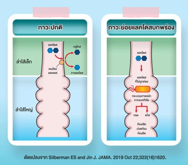 ความแตกต่างระหว่างภาวะย่อยแลคโตสบกพร่องและภาวะปกติ