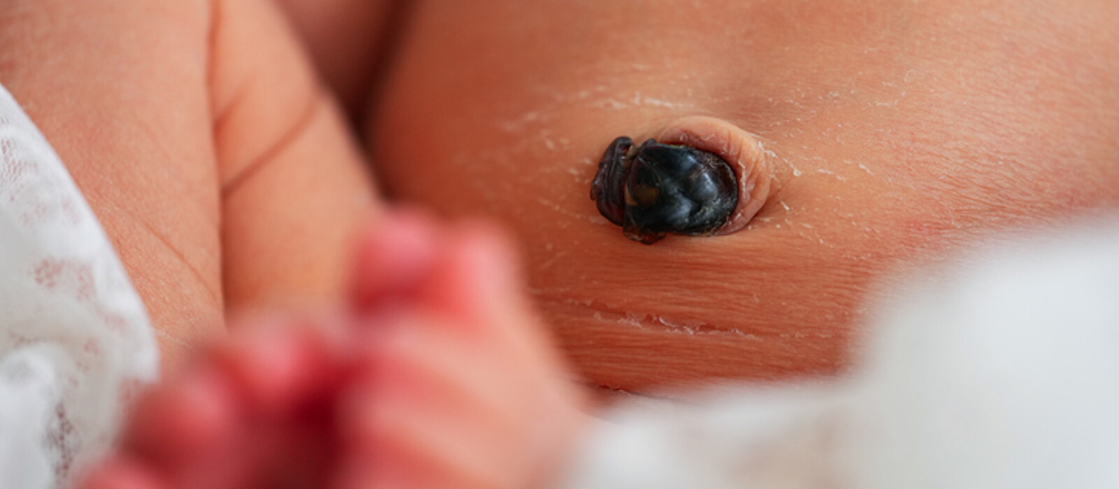 สายสะดือทารก สะดือใกล้หลุดเป็นแบบไหน พร้อมวิธีทำความสะอาด